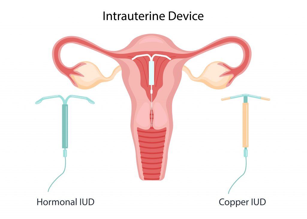 Hormonal IUD and copper IUD