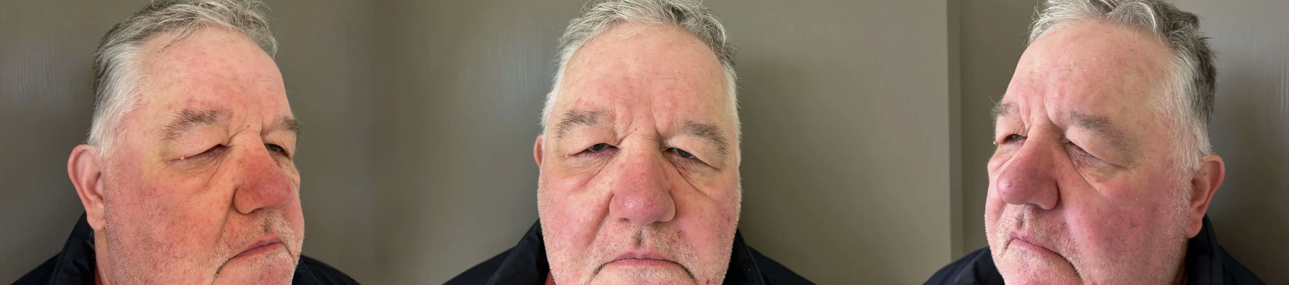 Before eyelid correction