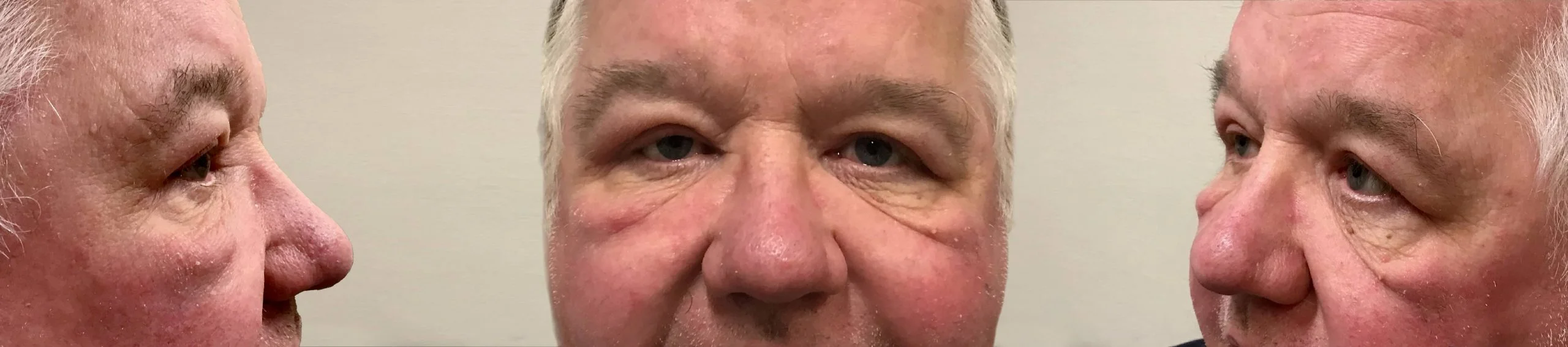 After eyelid correction