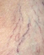 Spataderen