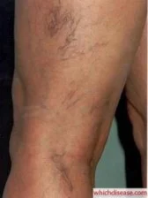 varicose veins