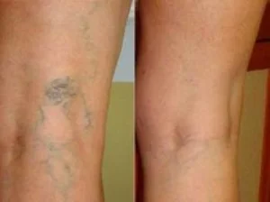 varicose veins