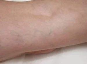 varicose veins
