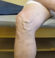 varicose veins