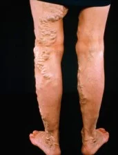 varicose veins